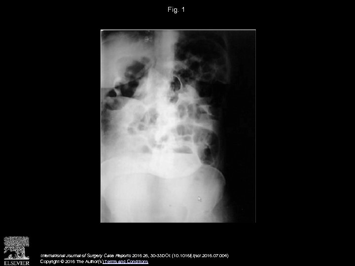 Fig. 1 International Journal of Surgery Case Reports 2016 26, 30 -33 DOI: (10.