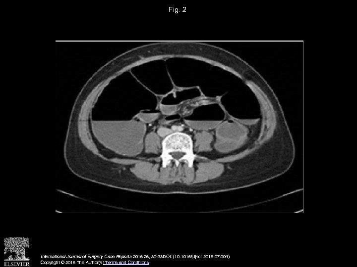 Fig. 2 International Journal of Surgery Case Reports 2016 26, 30 -33 DOI: (10.