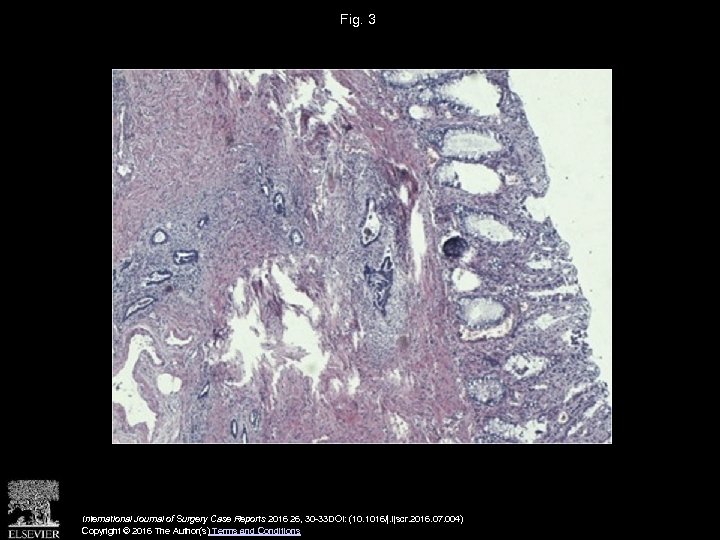 Fig. 3 International Journal of Surgery Case Reports 2016 26, 30 -33 DOI: (10.