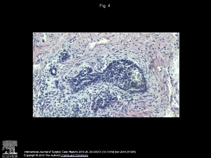 Fig. 4 International Journal of Surgery Case Reports 2016 26, 30 -33 DOI: (10.