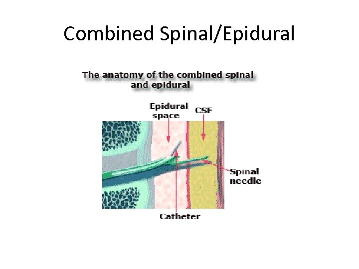 Combined Spinal/Epidural 