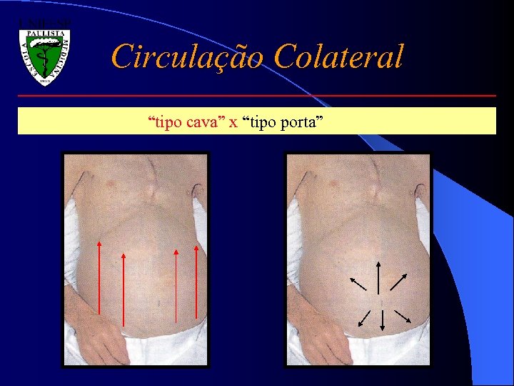 Circulação Colateral “tipo cava” x “tipo porta” 