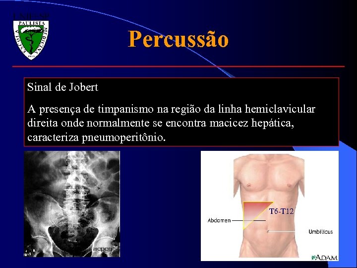 Percussão Sinal de Jobert A presença de timpanismo na região da linha hemiclavicular direita