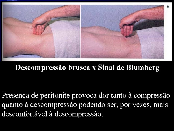 Descompressão brusca x Sinal de Blumberg Presença de peritonite provoca dor tanto à compressão