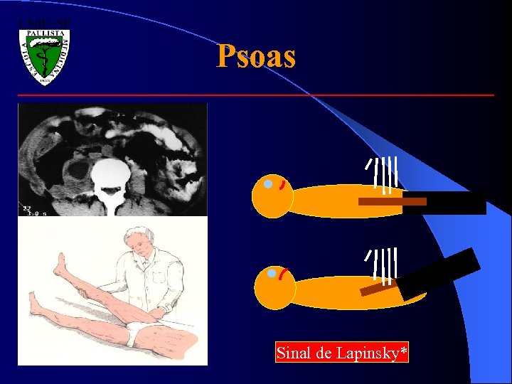 Psoas Sinal de Lapinsky* 