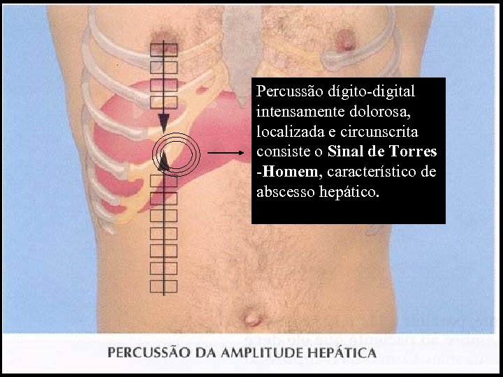 Percussão dígito-digital intensamente dolorosa, localizada e circunscrita consiste o Sinal de Torres -Homem, característico