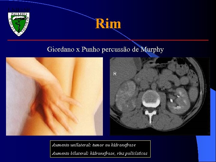 Rim Giordano x Punho percussão de Murphy Aumento unilateral: tumor ou hidronefrose Aumento bilateral: