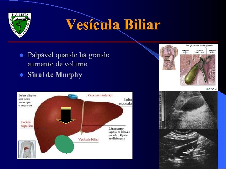 Vesícula Biliar Palpável quando há grande aumento de volume l Sinal de Murphy l