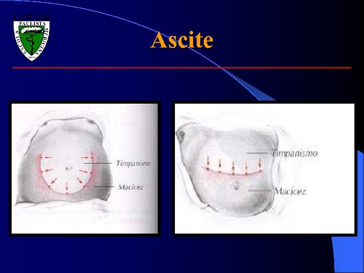 Ascite 