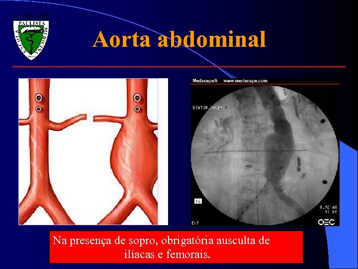 Aorta abdominal Na presença de sopro, obrigatória ausculta de ilíacas e femorais. 