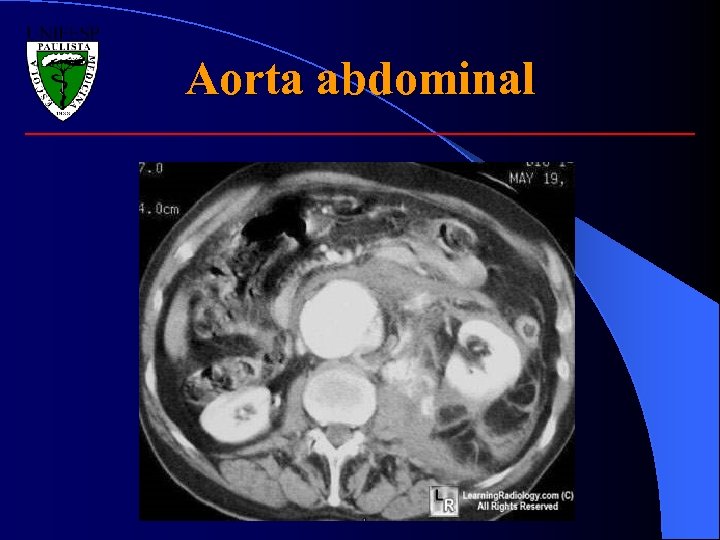 Aorta abdominal 