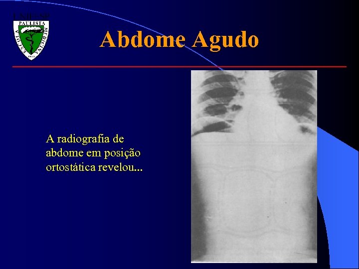 Abdome Agudo A radiografia de abdome em posição ortostática revelou. . . 