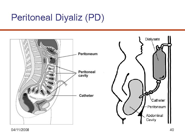 Peritoneal Diyaliz (PD) 04/11/2008 40 