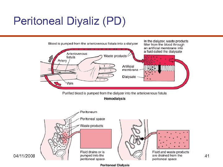 Peritoneal Diyaliz (PD) 04/11/2008 41 