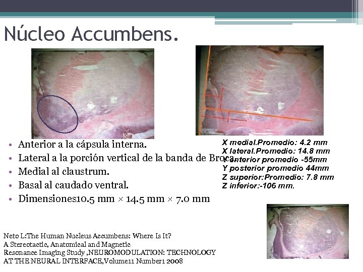 Núcleo Accumbens. • • • X medial. Promedio: 4. 2 mm Anterior a la