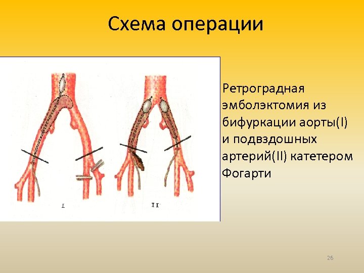 Схема операции • Ретроградная эмболэктомия из бифуркации аорты(I) и подвздошных артерий(II) катетером Фогарти 26