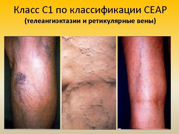 Класс С 1 по классификации СЕАР (телеангиэктазии и ретикулярные вены) 