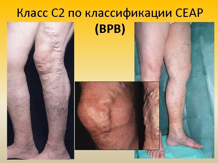 Класс С 2 по классификации СЕАР (ВРВ) 