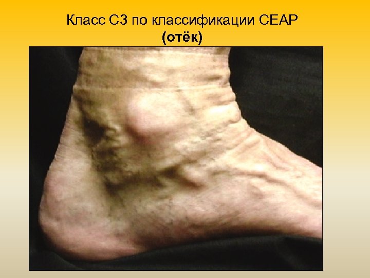 Класс С 3 по классификации СЕАР (отёк) 