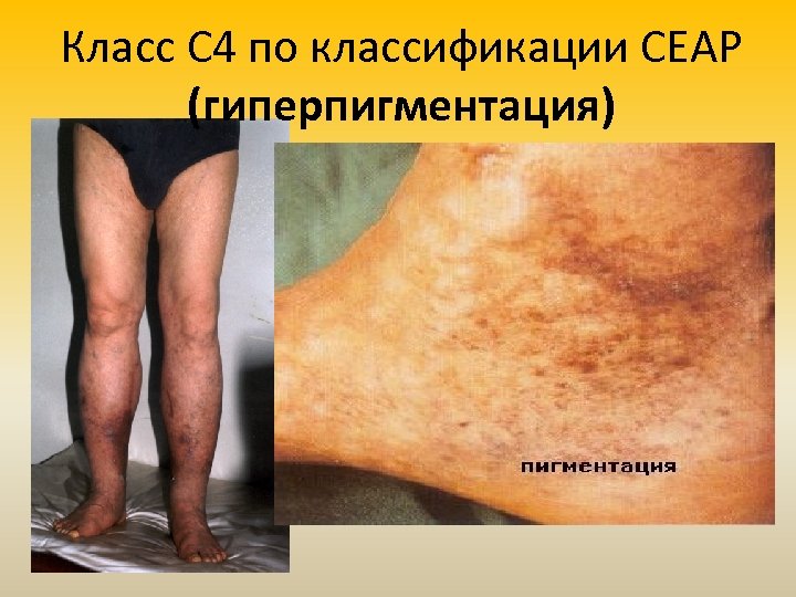 Класс С 4 по классификации СЕАР (гиперпигментация) 
