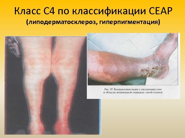 Класс С 4 по классификации СЕАР (липодерматосклероз, гиперпигментация) 