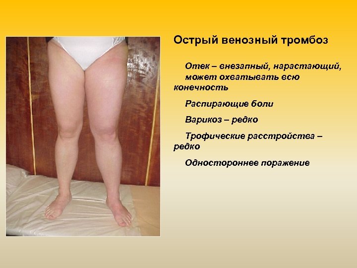 Острый венозный тромбоз Отек – внезапный, нарастающий, может охватывать всю конечность Распирающие боли Варикоз