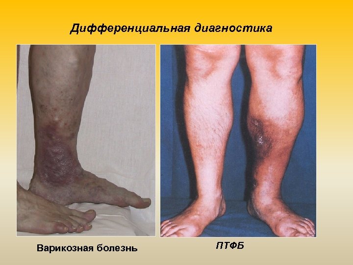 Дифференциальная диагностика Варикозная болезнь ПТФБ 