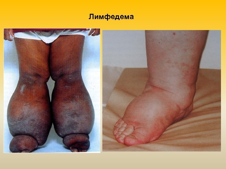 Лимфедема 