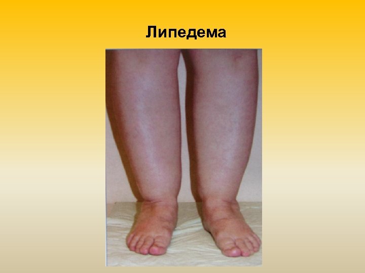 Липедема 
