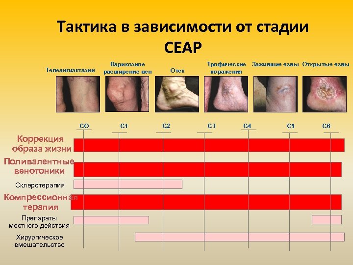 Тактика в зависимости от стадии СЕАР Телеангиэктазии СО Коррекция образа жизни Поливалентные венотоники Склеротерапия