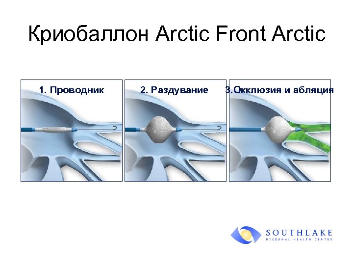 Криобаллон Arctic Front Arctic 1. Проводник 2. Раздувание 3. Окклюзия и абляция 