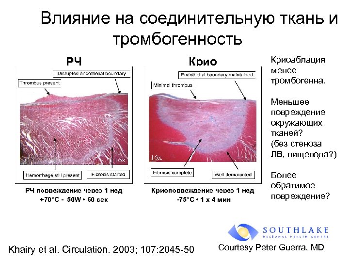 Влияние на соединительную ткань и тромбогенность РЧ Криоаблация менее тромбогенна. Крио Меньшее повреждение окружающих