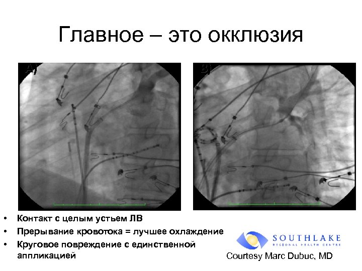 Главное – это окклюзия A) • • • B) Контакт с целым устьем ЛВ