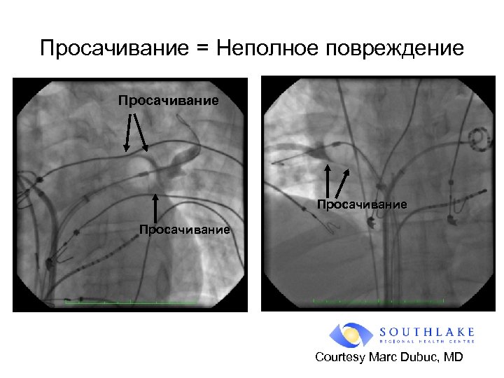 Просачивание = Неполное повреждение Просачивание Courtesy Marc Dubuc, MD 