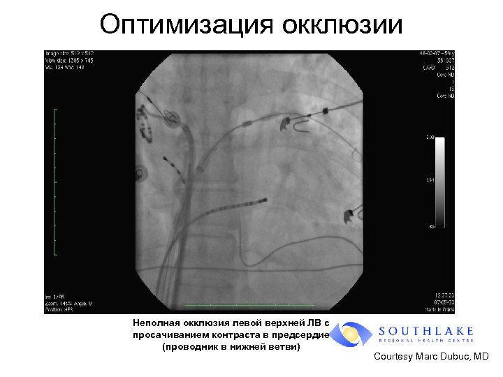 Оптимизация окклюзии Неполная окклюзия левой верхней ЛВ с просачиванием контраста в предсердие (проводник в