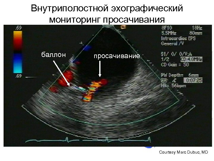 Внутриполостной эхографический мониторинг просачивания баллон просачивание Courtesy Marc Dubuc, MD 