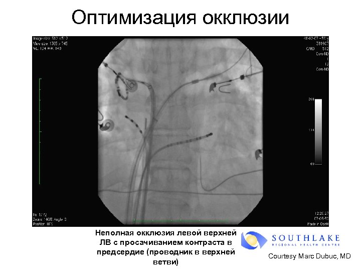 Оптимизация окклюзии Неполная окклюзия левой верхней ЛВ с просачиванием контраста в предсердие (проводник в