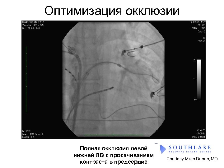 Оптимизация окклюзии Полная окклюзия левой нижней ЛВ с просачиванием контраста в предсердие Courtesy Marc