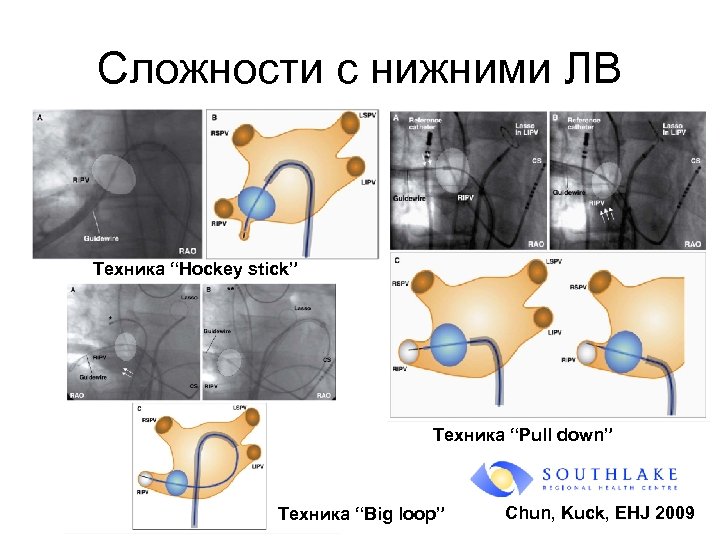 Сложности с нижними ЛВ Техника “Hockey stick” Техника “Pull down” Техника “Big loop” Chun,