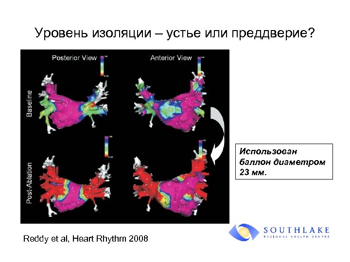 Уровень изоляции – устье или преддверие? Использован баллон диаметром 23 мм. Reddy et al,