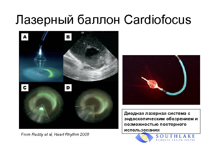 Лазерный баллон Cardiofocus From Reddy et al, Heart Rhythm 2008 Диодная лазерная система с