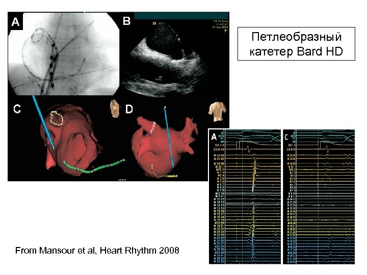 Петлеобразный катетер Bard HD From Mansour et al, Heart Rhythm 2008 