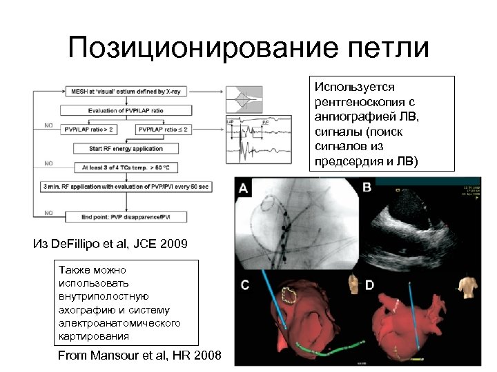 Позиционирование петли Используется рентгеноскопия с ангиографией ЛВ, сигналы (поиск сигналов из предсердия и ЛВ)