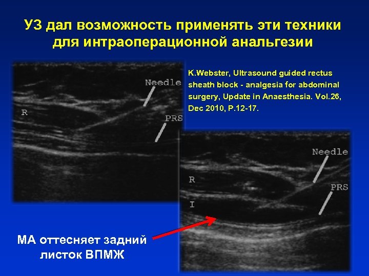 УЗ дал возможность применять эти техники для интраоперационной анальгезии K. Webster, Ultrasound guided rectus