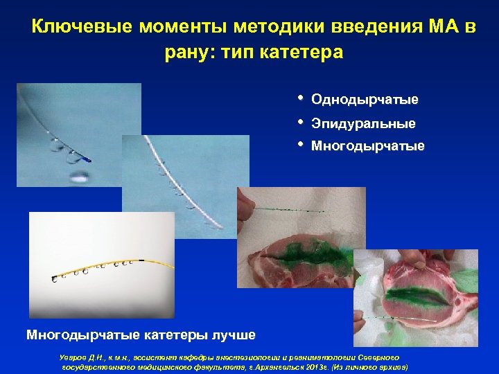 Ключевые моменты методики введения МА в рану: тип катетера • Однодырчатые • Эпидуральные •