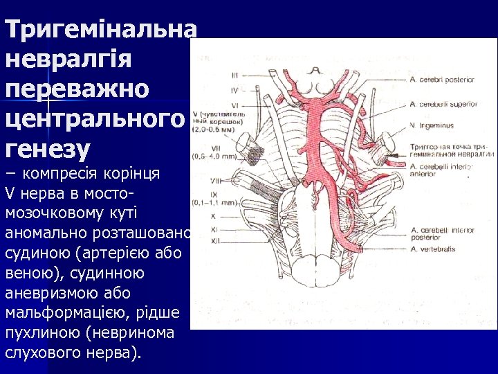 Тригемінальна невралгія переважно центрального генезу − компресія корінця V нерва в мостомозочковому куті аномально