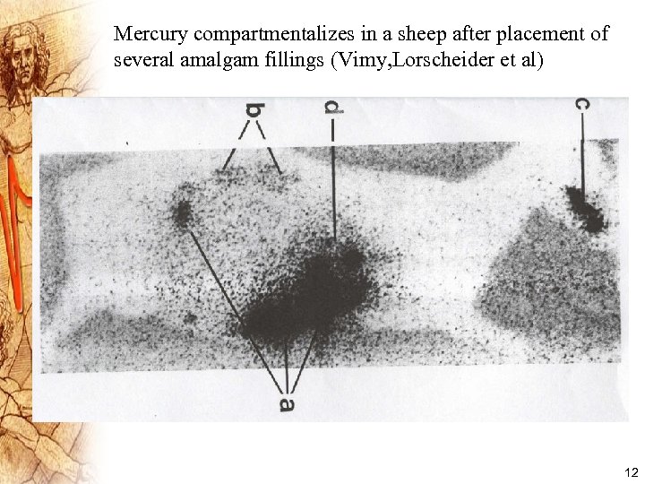 Mercury compartmentalizes in a sheep after placement of several amalgam fillings (Vimy, Lorscheider et