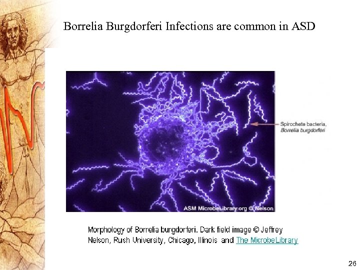 Borrelia Burgdorferi Infections are common in ASD 26 