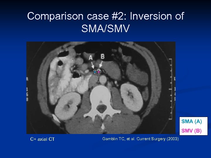 Comparison case #2: Inversion of SMA/SMV SMA (A) SMV (B) C+ axial CT Gamblin