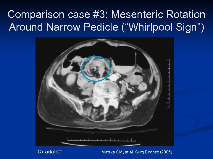 Comparison case #3: Mesenteric Rotation Around Narrow Pedicle (“Whirlpool Sign”) C+ axial CT Matzke